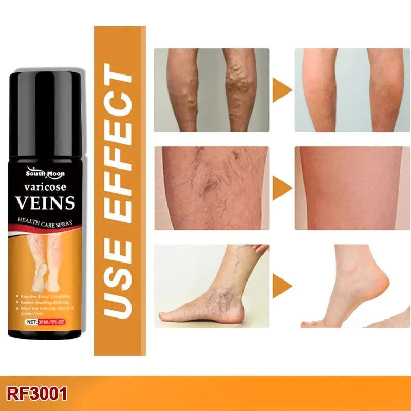 Bee Venom Spider Veins Spray 🔥 Buy 1 Get 1 Free 🔥