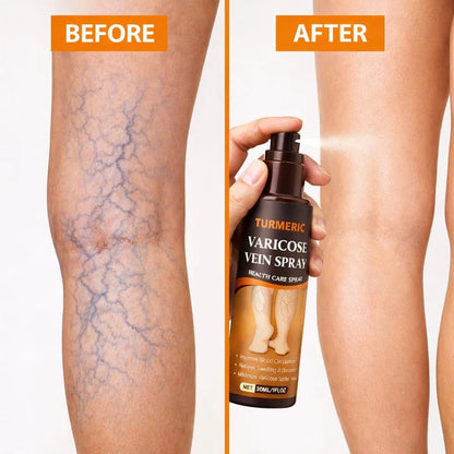 Bee Venom Spider Veins Spray 🔥 Buy 1 Get 1 Free 🔥
